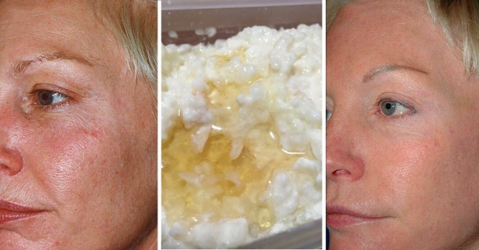 Botoxul se odihnește! Nu credeam că efectul va fi atât de vizibil.…