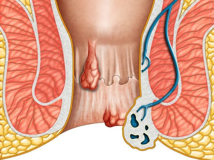 Cum de a ușura starea cu hemoroizi? Sfaturi utile