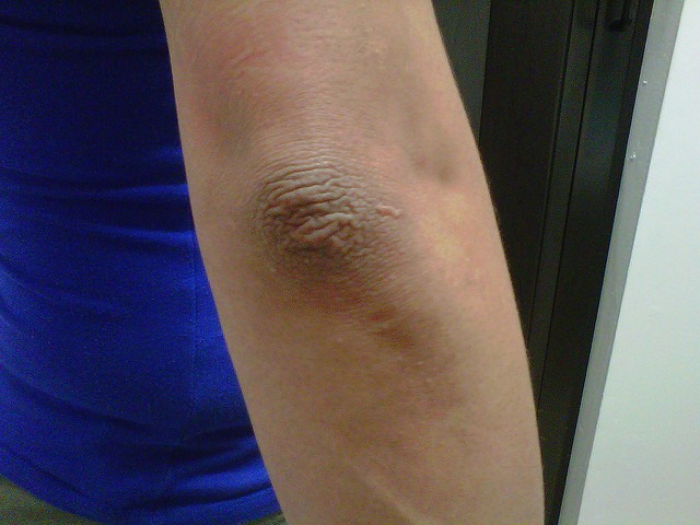 Albiți pielea întunecată pe coate și genunchi în doar 5 minute