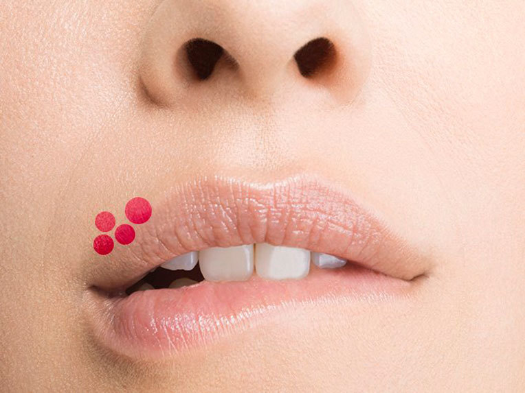 Cum să scapi de herpesul de pe buze într-o singura zi: 7 remedii