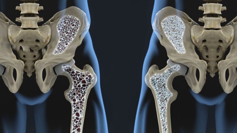 Tratament Osteoporoza