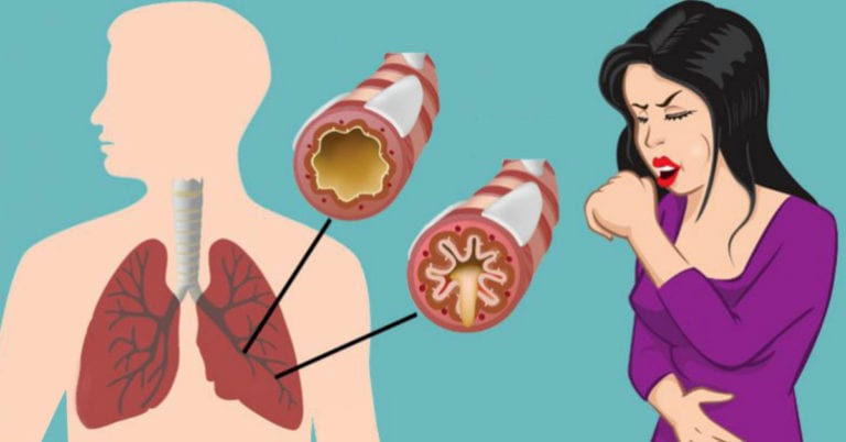 Modalități simple de a scăpa de mucus (Află ce ascund doctorii)