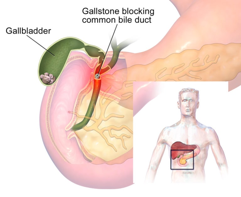 „Boala bunăstării”: cum să trăiești fără pietre în vezica biliară