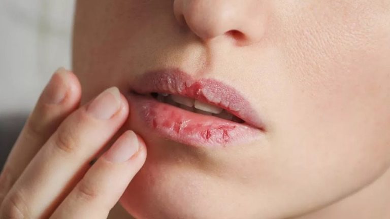 Ce să facem dacă avem buzele crăpate puternic