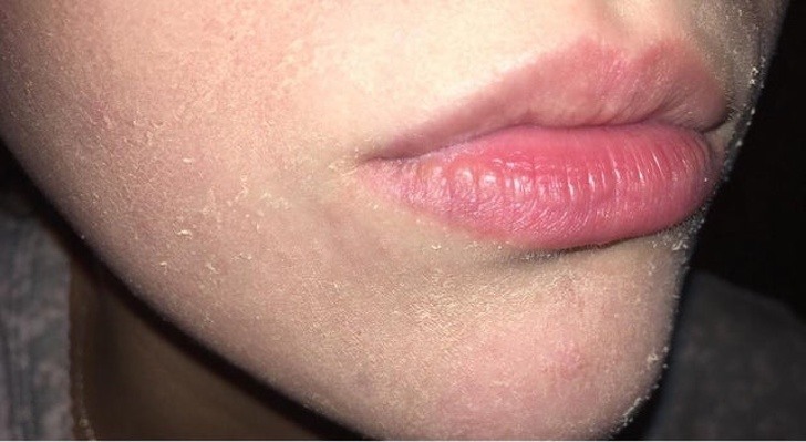 Semne de lipsă a vitaminei A