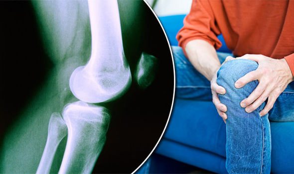 Soluție eficientă pentru artroză, artrită, osteocondroză (rețeta bunicii mele)