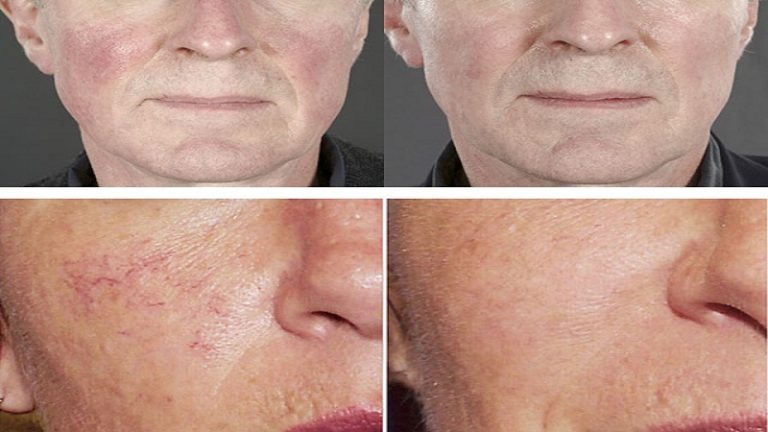 Cum să scapi de capilare ieșite pe față la domiciliu cu remedii ?