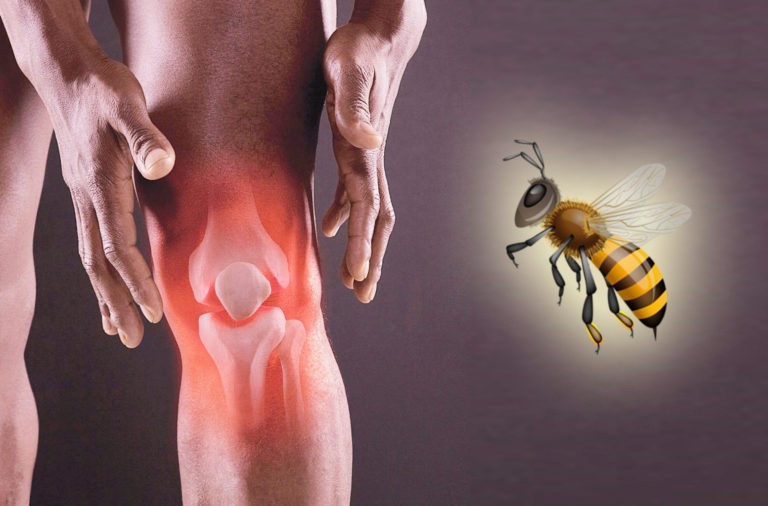 Tratamentul bolilor cu venin de albine / Reumatism, Hipertensiune arterială, Sistemul nervos, Astm Bronsic, Articulații etc.