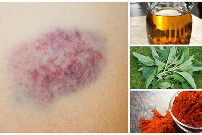Vânătăi – Tratament Cu Metode Remedii Naturiste – Medicina Tradițională