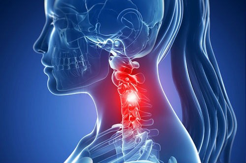 Spondiloza cervicală: simptome și tratament cu remedii naturiste