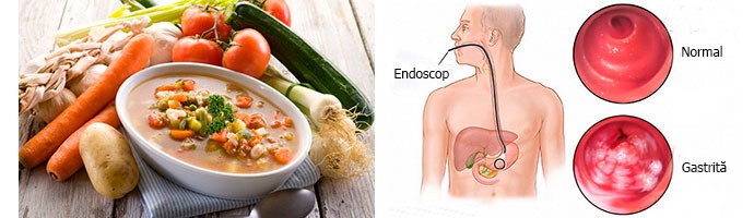 Caracteristicile nutriției în Agravarea gastritei