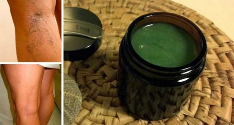 Un remediu minunat pentru vene varicoase