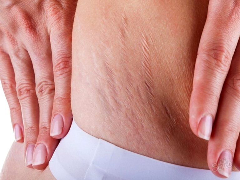 Cum să eliminăm vergeturile ?