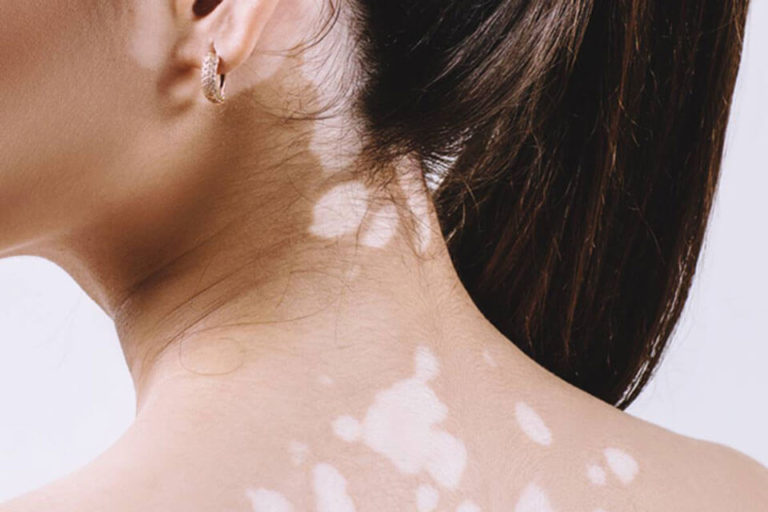 Vitiligo – Tratament cu Remedii Naturiste / Modalități inovatoare de tratament